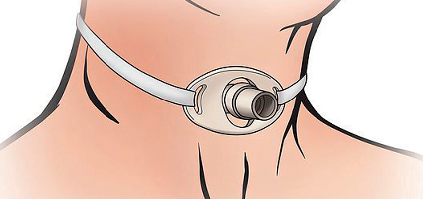 Traqueostomia: Indicações e Cuidados