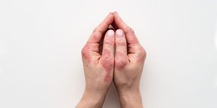 Dermatose Ocupacional: Prevenção e Tratamento