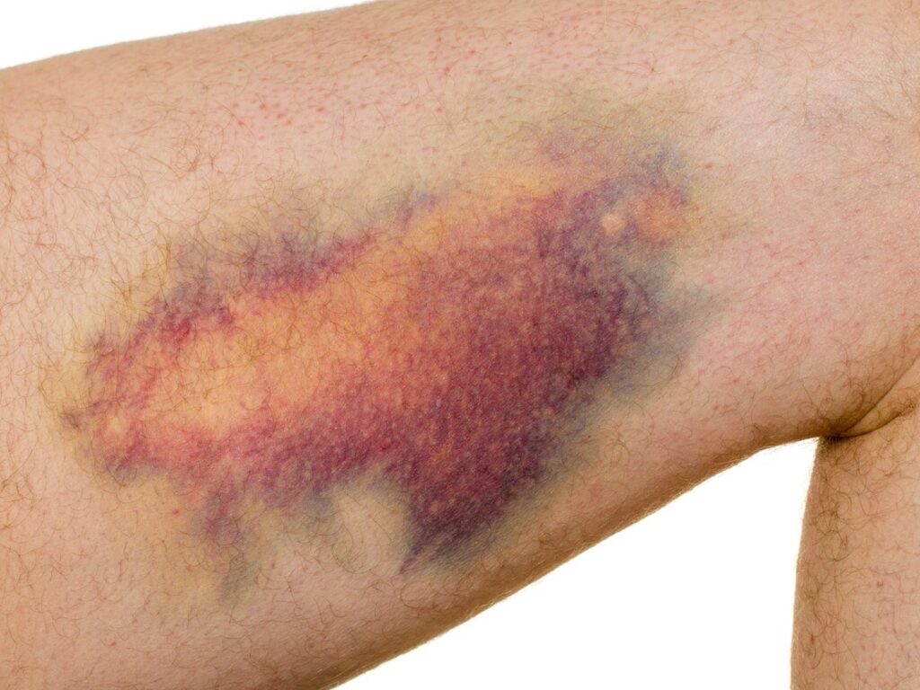 Hematoma: Causas e Tratamentos
