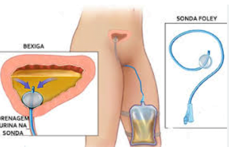  fixação da sonda nasogástrica